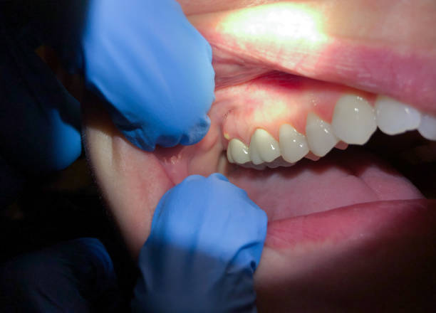 Best Broken or Chipped Tooth Repair in USA
